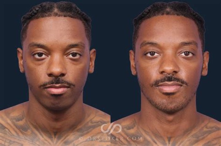 Michael B. Jordan Plastic Surgery: Look at His Face Before and After Jaw Surgery!